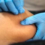 Casus Schouderklachten behandelen met Dry Needling - Fysiolinks